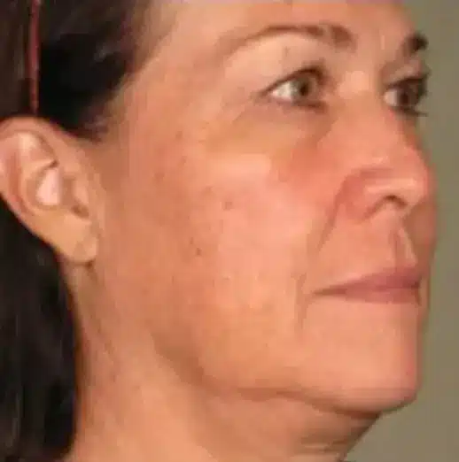 Ultherapy Lift - Before