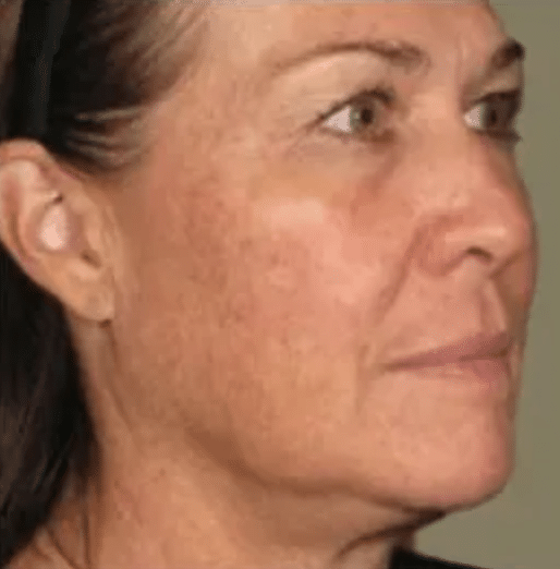 Ultherapy Lift - After