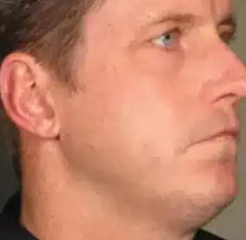 Ultherapy Lift - Before