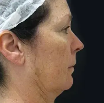 Ultherapy Lift - Before