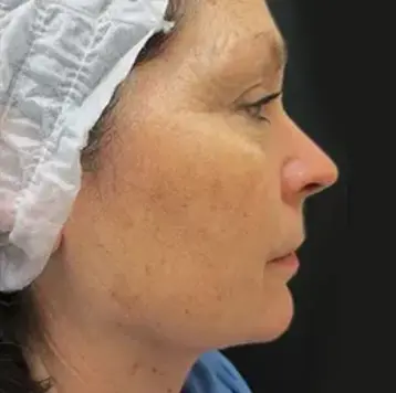 Ultherapy Lift - After