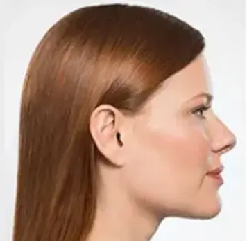 Kybella - After