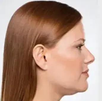 Kybella - Before